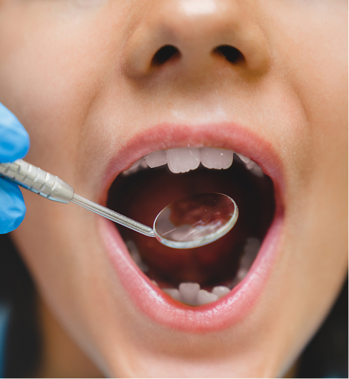 Close-up of a patient with mouth open during a dental exam as a dentist uses a mouth mirror to inspect the teeth.