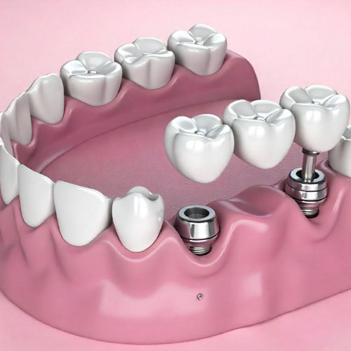 For this final image, the alt-text should focus on the technical structure of the dental restoration and how it integrates with the jaw. 1. Descriptive (General Purpose) "A 3D medical illustration of a dental bridge being fitted onto two metal dental implants in the lower jaw. The pink gums and white ceramic teeth are shown against a soft pink background, highlighting the hardware and the three-unit bridge structure.