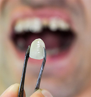 A pair of dental tweezers holds a white ceramic veneer or crown in sharp focus, with a blurred image of a patient's open mouth and missing front tooth in the background.