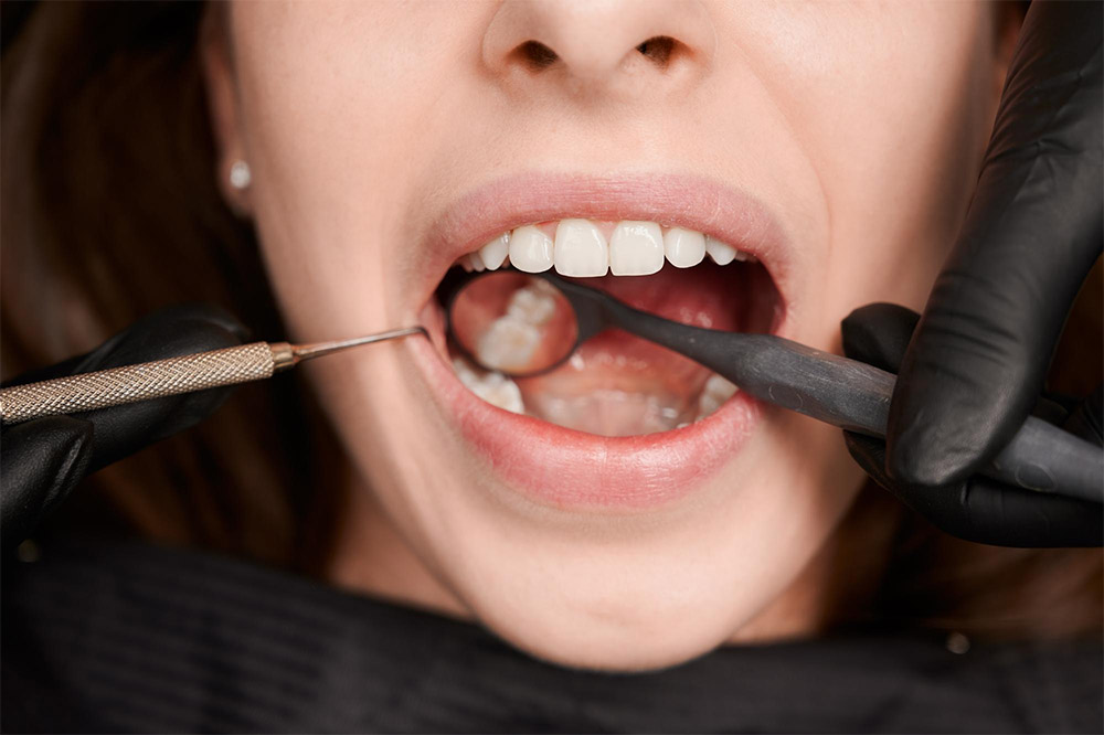 Dentist performing a tooth extraction using dental forceps while the patient’s mouth is open.