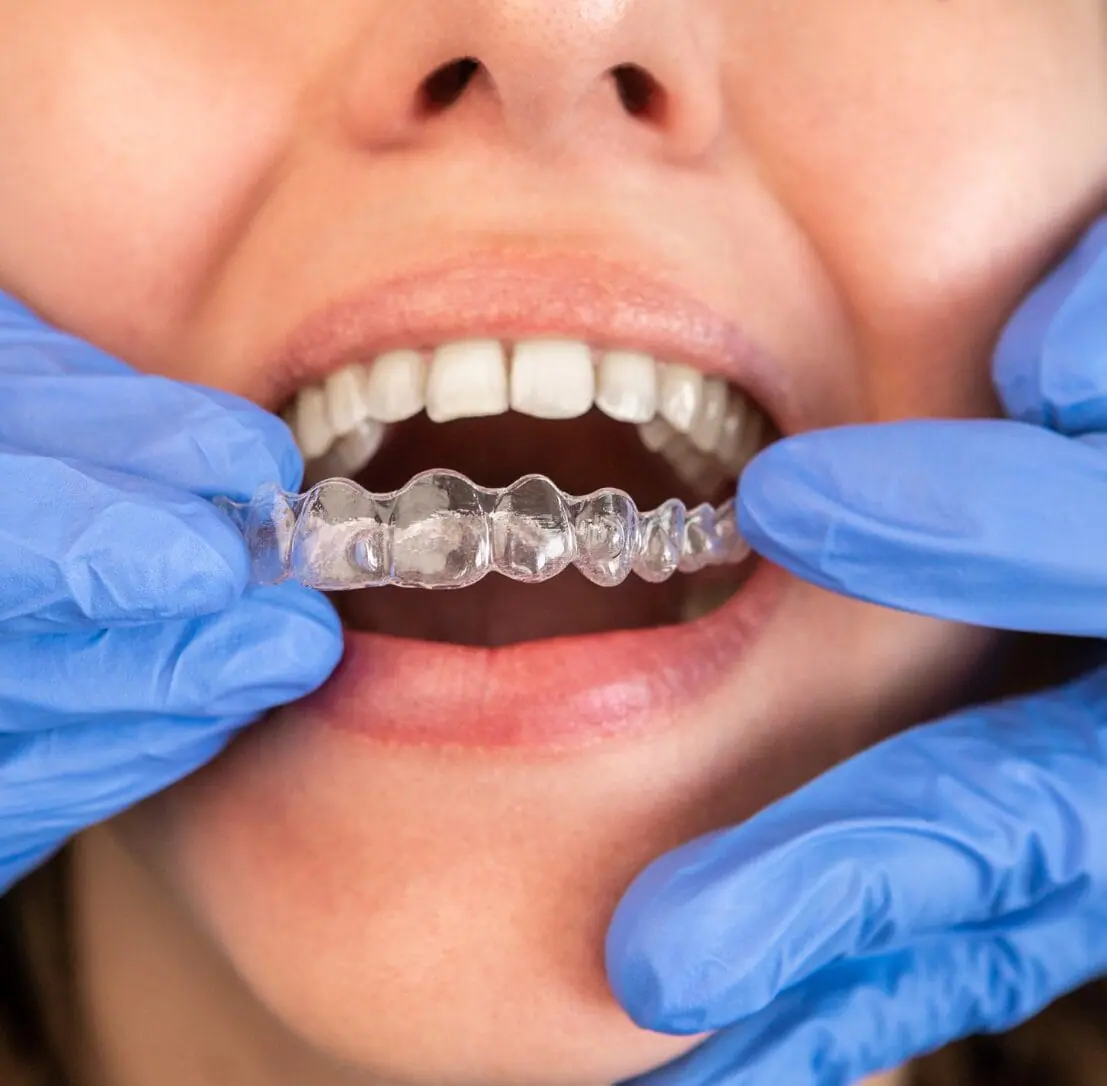 Invisalign Treatment